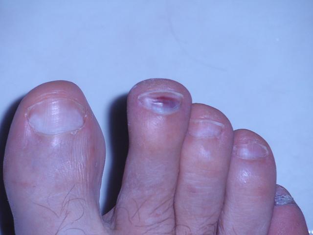 One toenail was red from downhill walkin